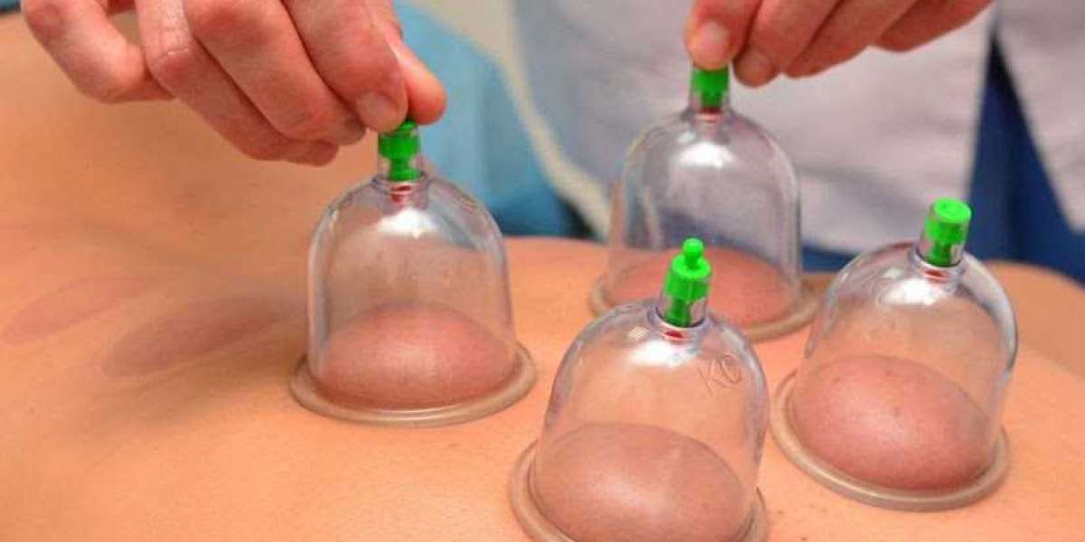 Hacamat Nedir Faydaları Nelerdir? Hacamat Kimlere Yapılmaz?