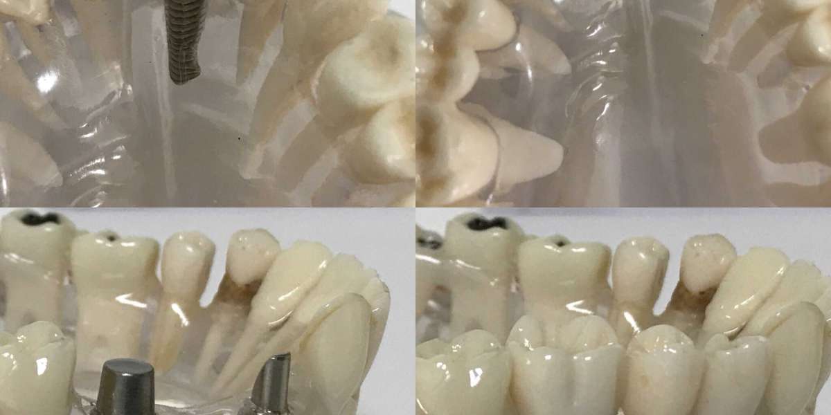 İmplant Uygulaması Nasıl Yapılır? İmplant Yaptırmaktan Korkuyorum?