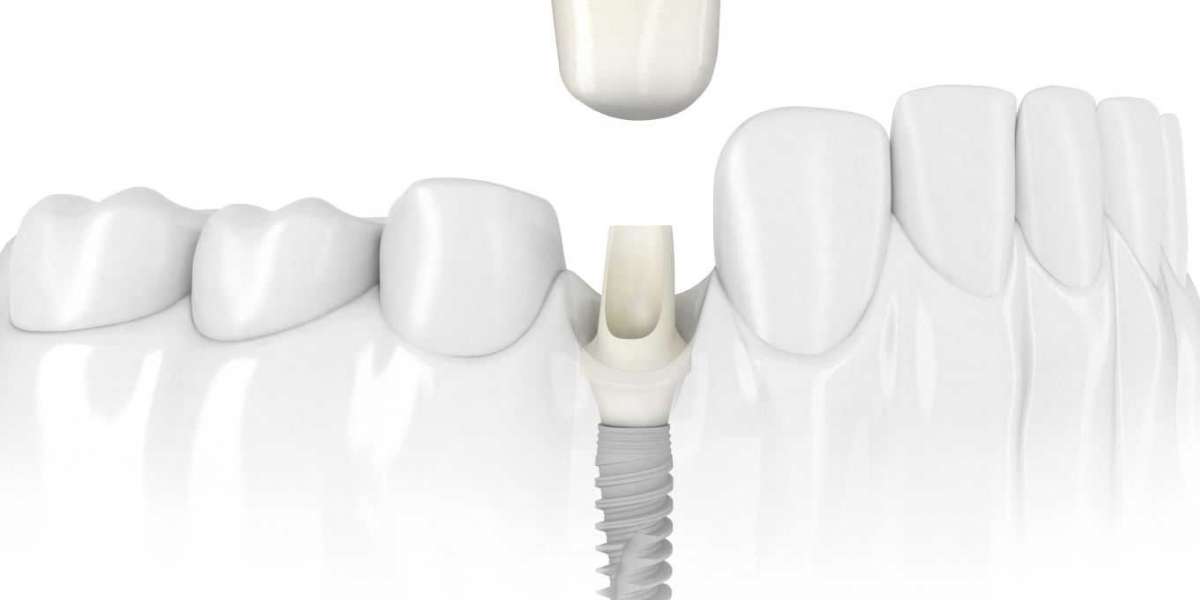 Vidasız İmplant Nedir? İmplant Tedavi Süreci? implant Nedir Nasıl Yapılır?