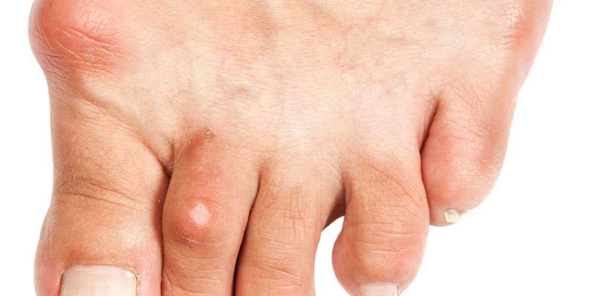 Gut Hastalığı Nedir? Gut Hastalığının Belirtileri? Gut Hastalığı Neden Olur?