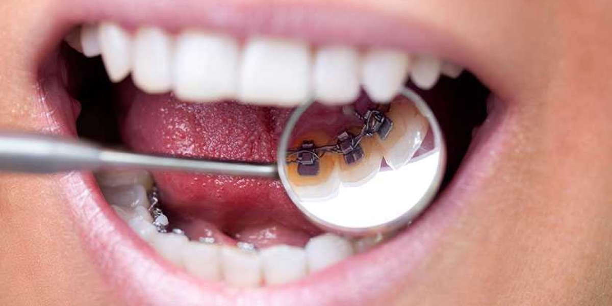 Ortodontik Tedavi Nasıl Yapılır? Ortodontik Tedavi Nedir?
