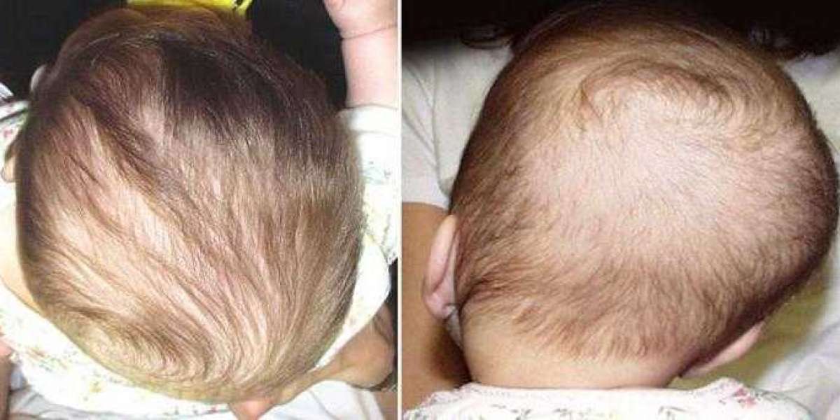 Metopik Sinostoz Nedir? Metopik Sinostoz Neden Olur? Belirtileri?