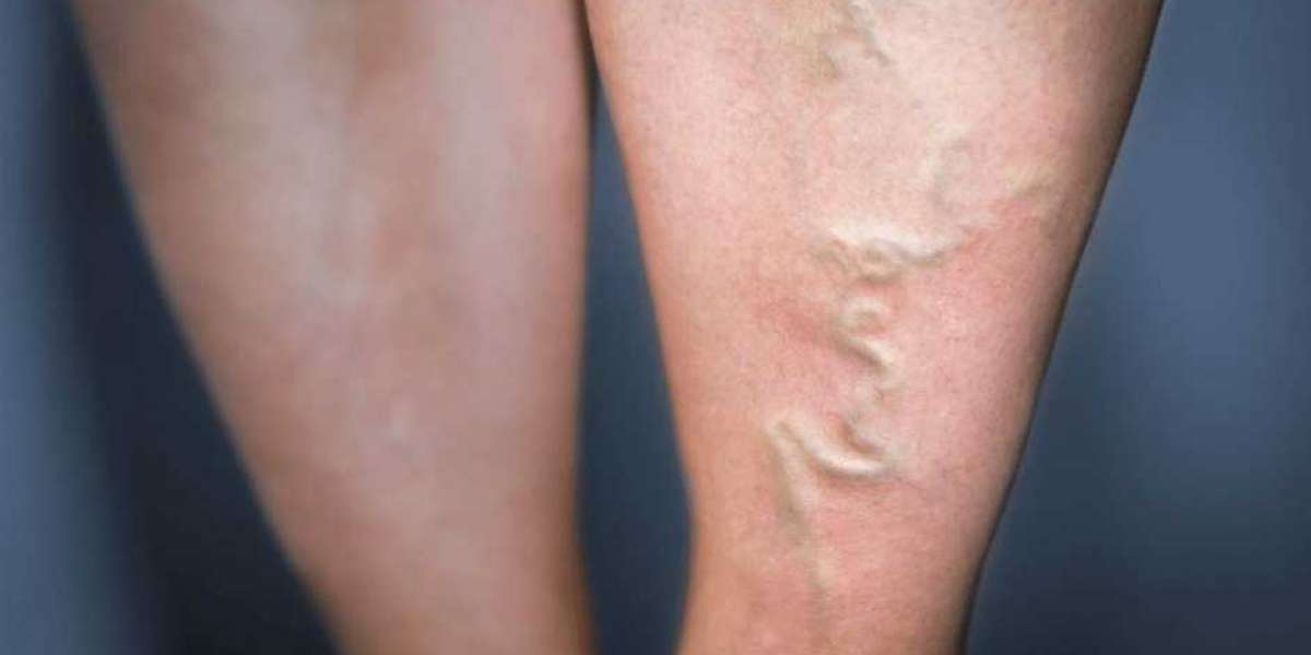 Varis İçin Hangi Doktora Gidilir? Kardiyoloji Varise Bakar Mı?
