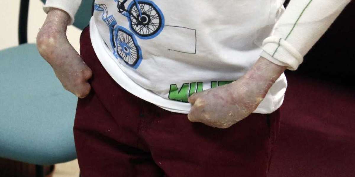 Kelebek Hastalığı Nedir? Kelebek Hastalığı Belirtileri?