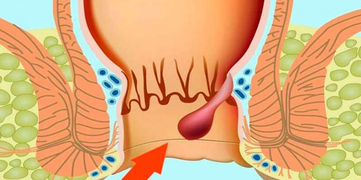 Basur İçin Hangi Doktora Gidilir? Basura Doktor Nasıl Bakar?