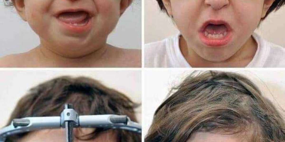 Crouzon Sendromu Nedir? Crouzon Sendromu Neden Olur?