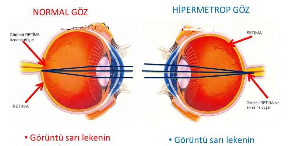 Görme Kusurları Nelerdir? Göz Hastalıkları Nelerdir?