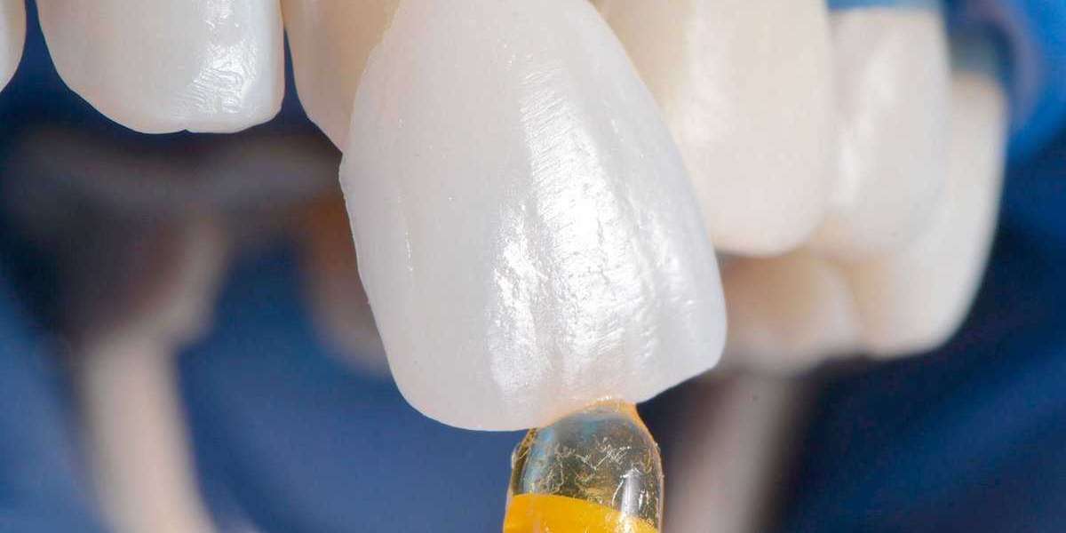 Laminate Veneer Nedir? Laminate Veneer Yaptıranların Yorumları?