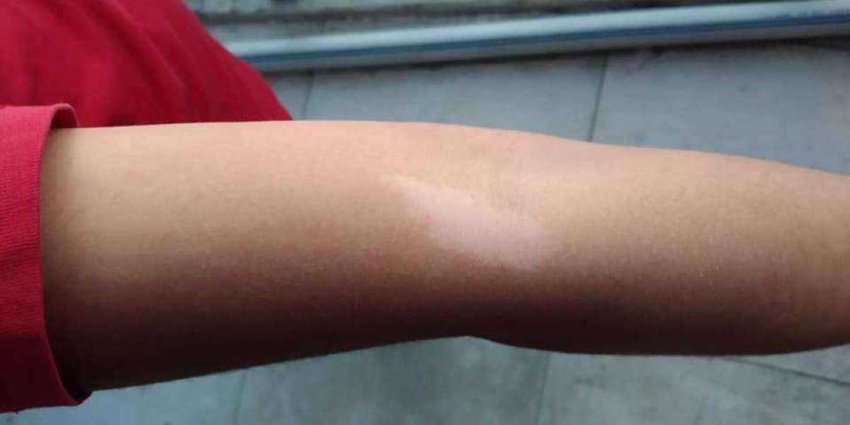 Vitiligo Nedir Belirtileri Nelerdir? Vitiligo Nedir Bulaşıcı Mıdır?